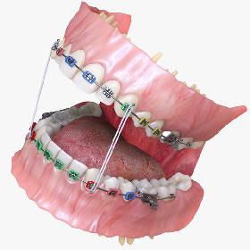 Permanent Dentition with Braces